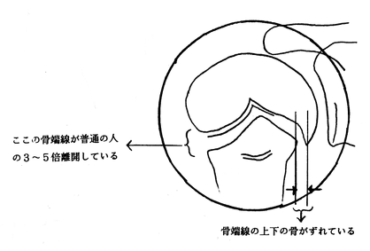 リトルリーガーズショルダーのレントゲン所見